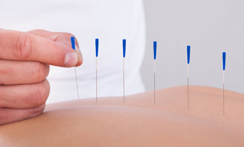 Akupunktur Nedir, Hangi Hastalıklara İyi Gelir