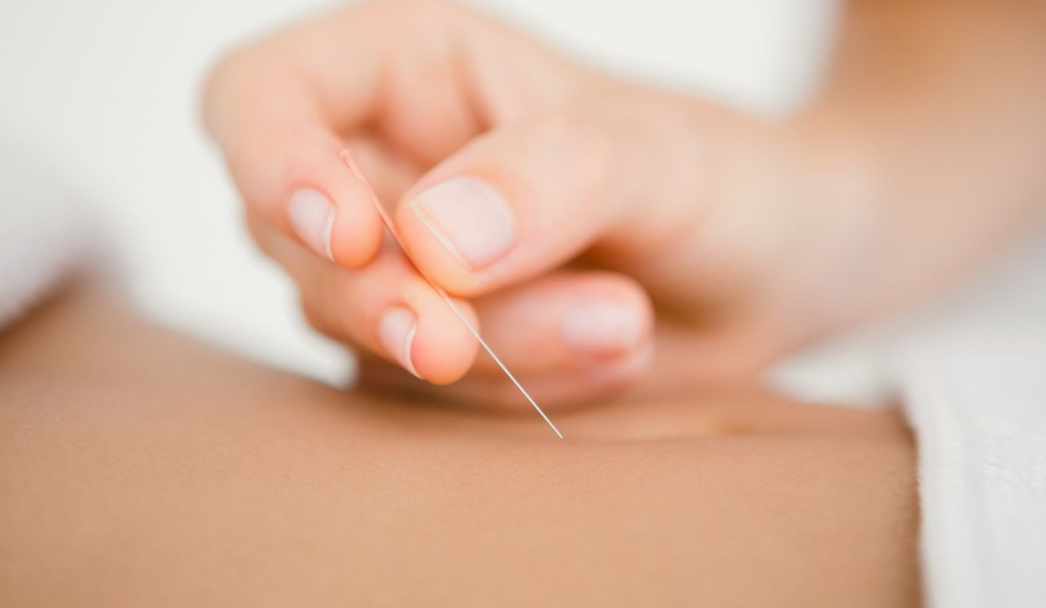 Akupunktur Nedir, Hangi Hastalıklara İyi Gelir1