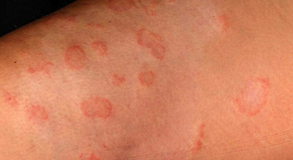 Cilt Mantar Hastalığı Nedir ve Nasıl Geçer? Wasquare