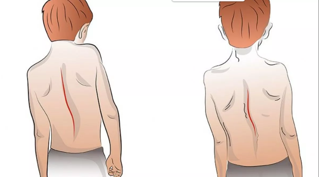 Çocuklarda Omurga Eğriliği Belirtileri Ve Korse Takmak