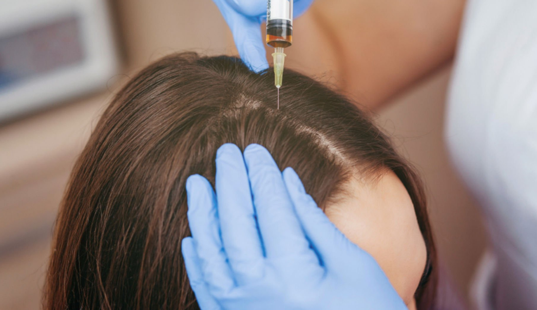 Dökülen Saçlar PRP İle Tedavi Edilir Mi