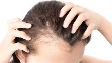 Dökülen Saçlar PRP İle Tedavi Edilir Mi1