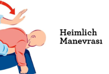 Heimlich Manevrası Nedir ve Nasıl Yapılır1