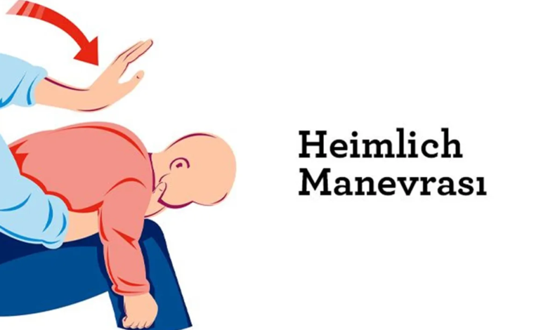 Heimlich Manevrası Nedir ve Nasıl Yapılır1