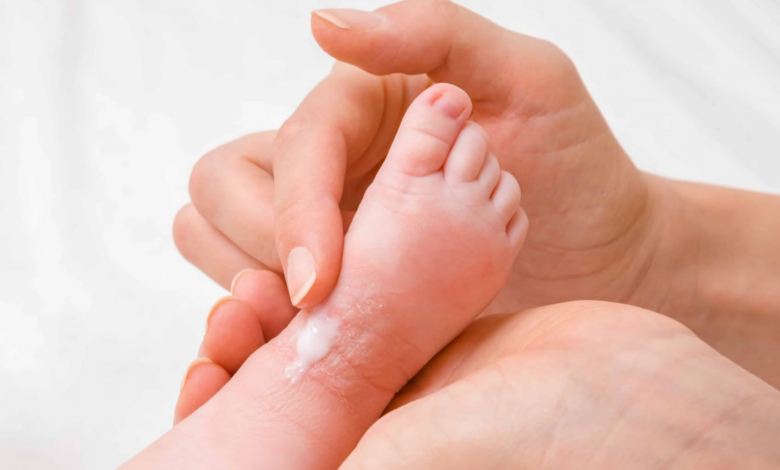 Bebeklerde Cilt Hastalıkları Tanı ve Önleme Yolları1