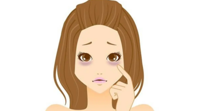 Göz Altı Morluklarına Etkili ve Doğal Çözüm Yöntemleri