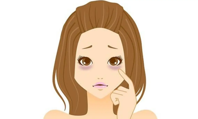 Göz Altı Morluklarına Etkili ve Doğal Çözüm Yöntemleri